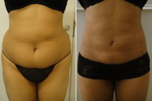 before-and-after-microlipo